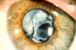 Травматическая катаракта